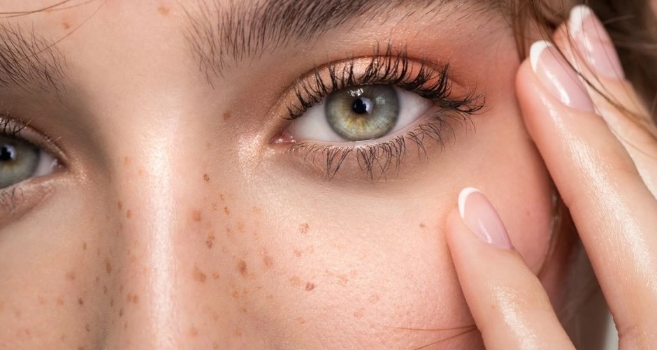 Freckles / Sommersprossen (2 hr)