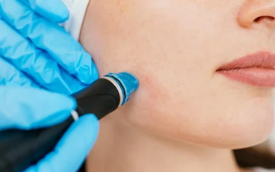 Entfesseln Sie Ihr inneres Strahlen: Die Kraft des Microneedlings und die Pflege danach