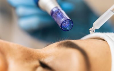 Microneedling und Hauterneuerung: Warum jetzt der perfekte Zeitpunkt ist